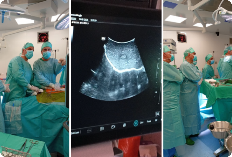 Opća bolnica Pula po prvi puta izvela intraoperativnu termalnu ablaciju metastaze u jetri-160775